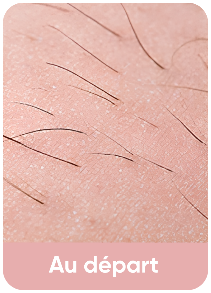 Debut - l epilateur  guerida 